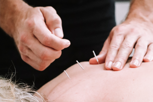 Dry Needling vs Acupuncture: What’s the Difference?